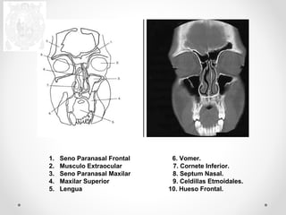 1. Seno Paranasal Frontal 6. Vomer. 
2. Musculo Extraocular 7. Cornete Inferior. 
3. Seno Paranasal Maxilar 8. Septum Nasal. 
4. Maxilar Superior 9. Celdillas Etmoidales. 
5. Lengua 10. Hueso Frontal. 
 