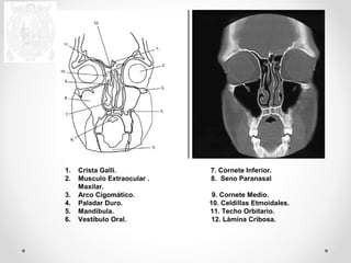 1. Crista Galli. 7. Cornete Inferior. 
2. Musculo Extraocular . 8. Seno Paranasal 
Maxilar. 
3. Arco Cigomático. 9. Cornete Medio. 
4. Paladar Duro. 10. Celdillas Etmoidales. 
5. Mandíbula. 11. Techo Orbitario. 
6. Vestíbulo Oral. 12. Lámina Cribosa. 
 