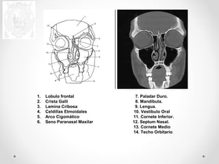 1. Lobulo frontal 7. Paladar Duro. 
2. Crista Galli 8. Mandíbula. 
3. Lamina Cribosa 9. Lengua. 
4. Celdillas Etmoidales 10. Vestíbulo Oral 
5. Arco Cigomático 11. Cornete Inferior. 
6. Seno Paranasal Maxilar 12. Septum Nasal. 
13. Cornete Medio 
14. Techo Orbitario. 
 