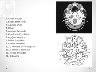 1. Globo ocular 
2. Hueso Esfenoidal 
3. Agujero Oval 
4. Clivus 
5. Agujero Rasgado 
6. Conducto Carotideo 
7. Agujero Yugular 
8. Bulbo Raquídeo 
9. Arteria Vertebral 
10. Conducto del Hipogloso 
11. Cóndilo Mandibular 
12. Hueso Etmoidal 
13. Cristalino 
 
