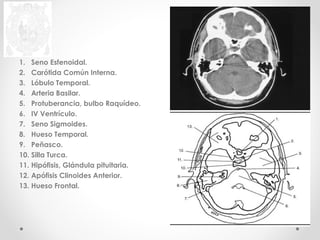 1. Seno Esfenoidal. 
2. Carótida Común Interna. 
3. Lóbulo Temporal. 
4. Arteria Basilar. 
5. Protuberancia, bulbo Raquídeo. 
6. IV Ventrículo. 
7. Seno Sigmoides. 
8. Hueso Temporal. 
9. Peñasco. 
10. Silla Turca. 
11. Hipófisis, Glándula pituitaria. 
12. Apófisis Clinoides Anterior. 
13. Hueso Frontal. 
 