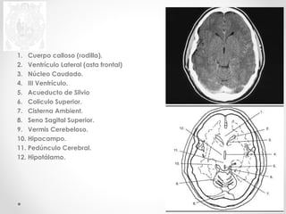 1. Cuerpo calloso (rodilla). 
2. Ventrículo Lateral (asta frontal) 
3. Núcleo Caudado. 
4. III Ventrículo. 
5. Acueducto de Silvio 
6. Coliculo Superior. 
7. Cisterna Ambient. 
8. Seno Sagital Superior. 
9. Vermis Cerebeloso. 
10. Hipocampo. 
11. Pedúnculo Cerebral. 
12. Hipotálamo. 
 