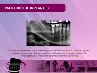 EVALUACIÓN DE IMPLANTES




  Es importante analizar la posición en la que se colocó el implante, su relación con los
       dientes adyacentes y las características del hueso que rodea al implante. Se
                debe observar la integración del implante con el tejido óseo.
 