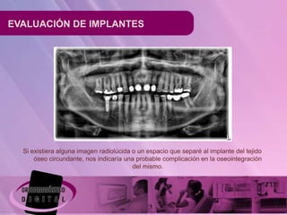 EVALUACIÓN DE IMPLANTES




  Si existiera alguna imagen radiolúcida o un espacio que separé al implante del tejido
      óseo circundante, nos indicaría una probable complicación en la oseointegración
                                         del mismo.
 