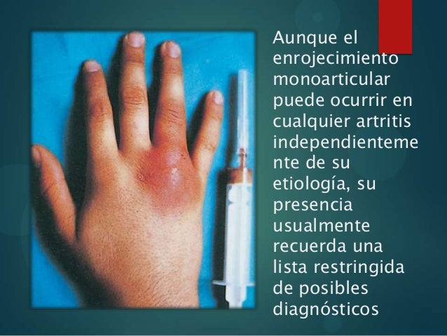 reumatismo palindromico