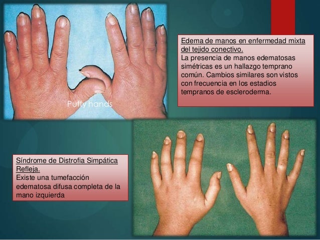 ARTRITIS SERONEGATIVA PDF