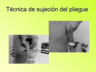 Técnica de sujeción del pliegue
 