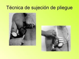 Técnica de sujeción de pliegue
 