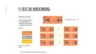 Hirschberg Test Normal EVALUACIÓN ESTRABOLÓGICA OFTALMOPEDIATRIA.pptx