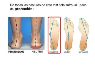 De todas las posturas de este test solo sufro un  poco de   pronación: 