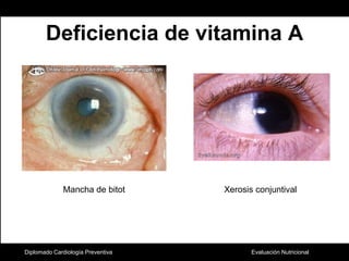 Deficiencia de vitamina ADiplomado Cardiología PreventivaMancha de bitotXerosis conjuntival