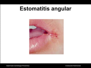 Estomatitis angularDiplomado Cardiología Preventiva