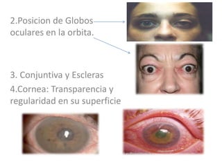 2.Posicion de Globos
oculares en la orbita.
3. Conjuntiva y Escleras
4.Cornea: Transparencia y
regularidad en su superficie
 