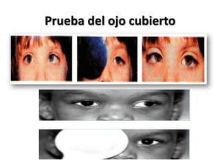 Prueba del ojo cubierto
 