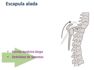 Escapula alada
• Nervio torácico largo
• Debilidad de Serratos
 