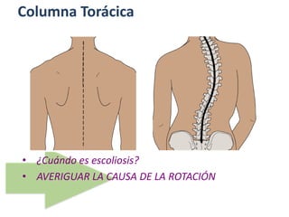 Columna Torácica
• ¿Cuándo es escoliosis?
• AVERIGUAR LA CAUSA DE LA ROTACIÓN
 