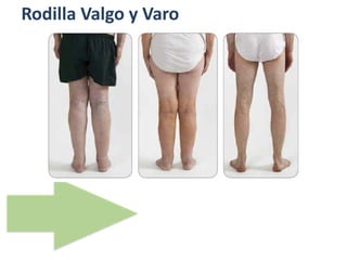 Rodilla Valgo y Varo
 