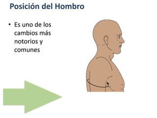 Posición del Hombro
• Es uno de los
cambios más
notorios y
comunes
 