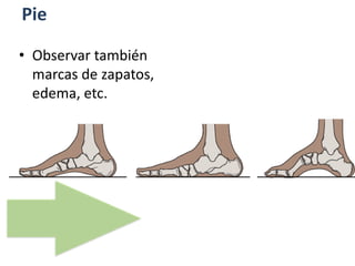 Pie
• Observar también
marcas de zapatos,
edema, etc.
 