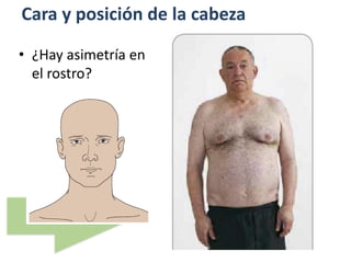 Cara y posición de la cabeza
• ¿Hay asimetría en
el rostro?
 