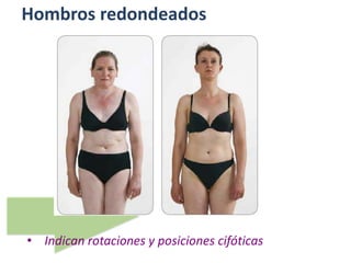 Hombros redondeados
• Indican rotaciones y posiciones cifóticas
 