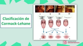 Clasificación de
Cormack-Lehane
 