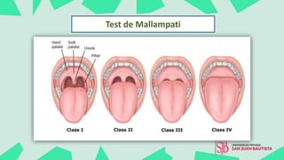 Test de Mallampati
 