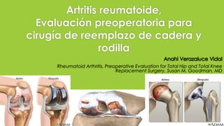 Artritis reumatoide,
Evaluación preoperatoria para
cirugía de reemplazo de cadera y
rodilla
Rheumatoid Arthritis, Preoperative Evaluation for Total Hip and Total Knee
Replacement Surgery, Susan M. Goodman, MD
 