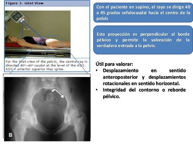 Evaluación radiográfica de la pelvis