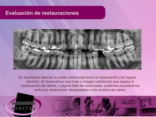 Evaluación de restauraciones




    Es importante detectar si existe continuidad entre la restauración y el órgano
         dentario. Si observamos una línea o imagen radiolúcida que separa la
     restauración del diente, o alguna falta de continuidad, podemos encontrarnos
              ante una restauración desajustada o una recidiva de caries.
 