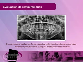 Evaluación de restauraciones




  Es conveniente evaluar de forma periódica este tipo de restauraciones, para
           detectar oportunamente cualquier alteración en las mismas.
 