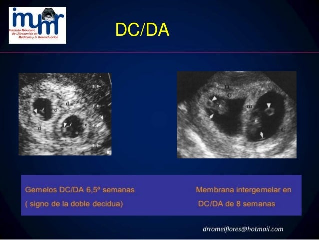 Evaluacion ultrasonografica de la gestacion gemelar dr. romel f