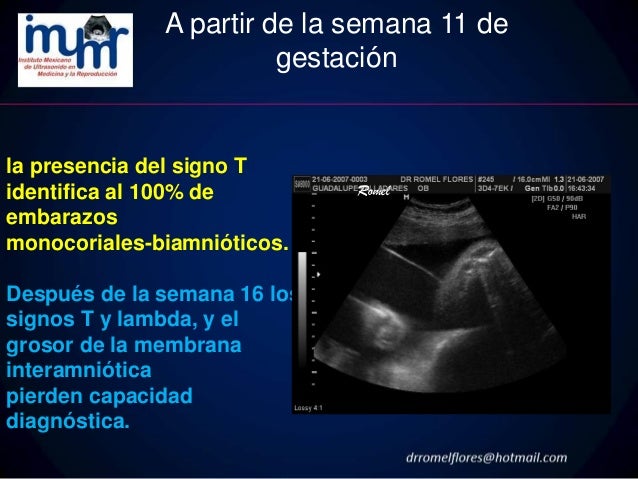 Evaluacion ultrasonografica de la gestacion gemelar dr. romel f