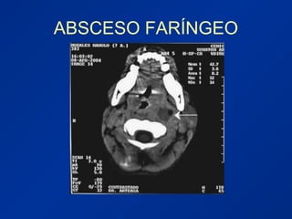 ABSCESO FARÍNGEO
 