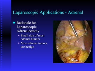 Laparoscopic Applications - Adrenal Rationale for Laparoscopic Adrenalectomy Small size of most adrenal tumors Most adrenal tumors are benign 