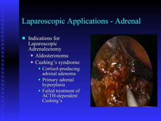 Laparoscopic Applications - Adrenal Indications for Laparoscopic Adrenalectomy Aldosteronoma Cushing’s syndrome Cortisol-producing adrenal adenoma Primary adrenal hyperplasia Failed treatment of ACTH-dependent Cushing’s 