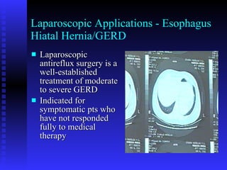 Laparoscopic Applications - Esophagus Hiatal Hernia/GERD Laparoscopic antireflux surgery is a well-established treatment of moderate to severe GERD Indicated for symptomatic pts who have not responded fully to medical therapy  