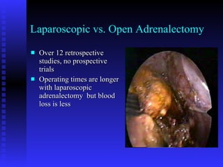 Laparoscopic vs. Open Adrenalectomy Over 12 retrospective studies, no prospective trials Operating times are longer with laparoscopic adrenalectomy  but blood loss is less 