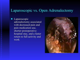 Laparoscopic vs. Open Adrenalectomy Laparoscopic adrenalectomy associated with decreased pain and pain medication use, shorter postoperative hospital stay, and a faster return to full activity and work 
