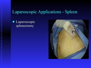 Laparoscopic Applications - Spleen Laparoscopic splenectomy 