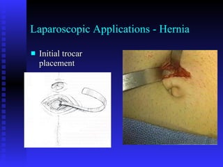 Laparoscopic Applications - Hernia Initial trocar placement 