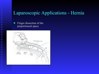 Laparoscopic Applications - Hernia Finger dissection of the preperitoneal space 
