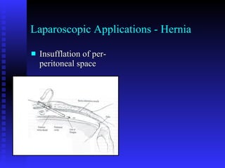 Laparoscopic Applications - Hernia Insufflation of per-peritoneal space 