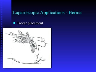 Laparoscopic Applications - Hernia Trocar placement 
