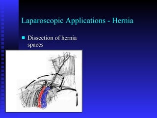 Laparoscopic Applications - Hernia Dissection of hernia spaces 