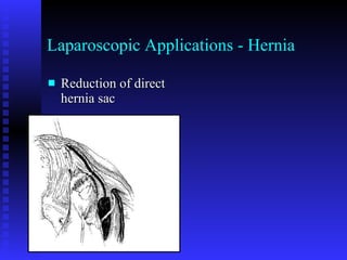 Laparoscopic Applications - Hernia Reduction of direct hernia sac 