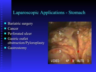 Laparoscopic Applications - Stomach Bariatric surgery Cancer Perforated ulcer Gastric outlet obstruction/Pyloroplasty Gastrostomy 