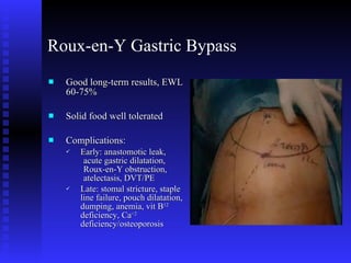 Roux-en-Y Gastric Bypass Good long-term results, EWL 60-75% Solid food well tolerated Complications: Early: anastomotic leak,  acute gastric dilatation,  Roux-en-Y obstruction,  atelectasis, DVT/PE Late: stomal stricture, staple line failure, pouch dilatation, dumping, anemia, vit B 12  deficiency, Ca +2  deficiency/osteoporosis 