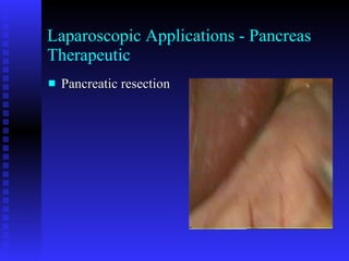 Laparoscopic Applications - Pancreas Therapeutic Pancreatic resection 