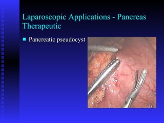 Laparoscopic Applications - Pancreas Therapeutic Pancreatic pseudocyst 
